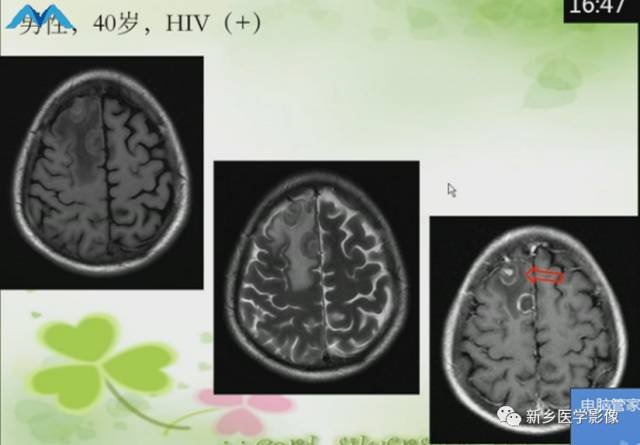 【PPT】颅内“靶征”疾病的影像诊断与鉴别