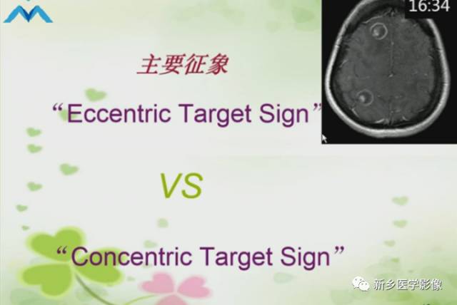 【PPT】颅内“靶征”疾病的影像诊断与鉴别