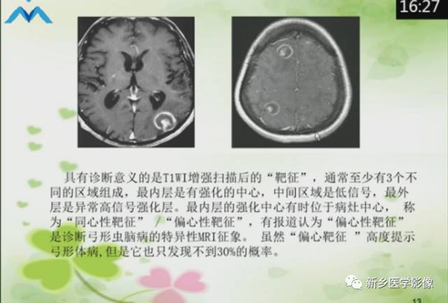 【PPT】颅内“靶征”疾病的影像诊断与鉴别
