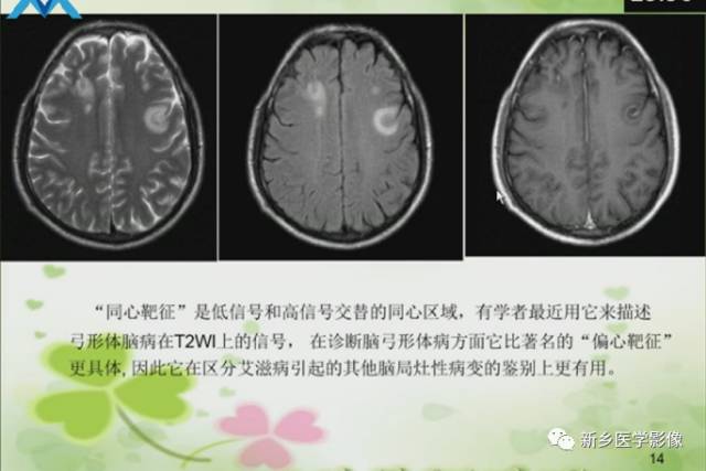 【PPT】颅内“靶征”疾病的影像诊断与鉴别