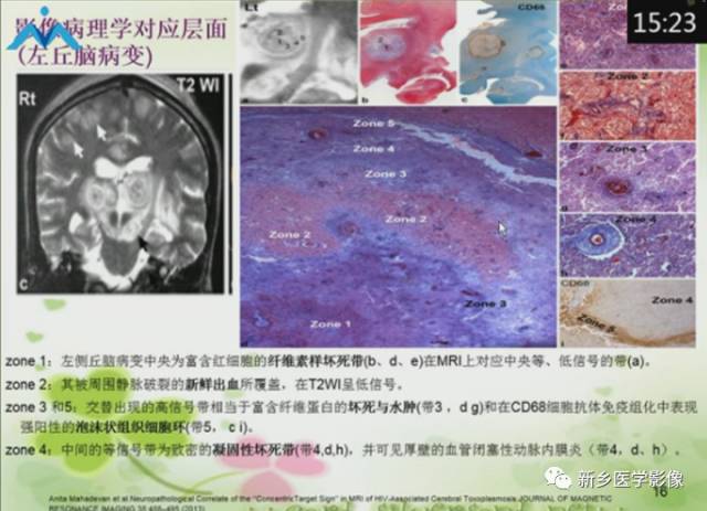 【PPT】颅内“靶征”疾病的影像诊断与鉴别