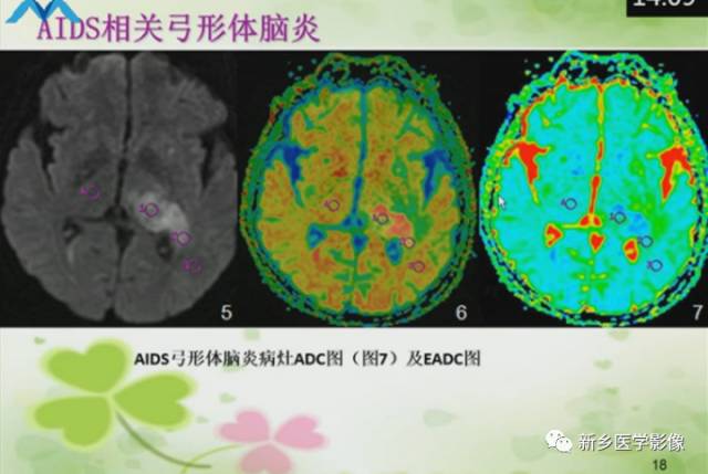 【PPT】颅内“靶征”疾病的影像诊断与鉴别