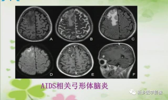 【PPT】颅内“靶征”疾病的影像诊断与鉴别