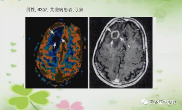 【PPT】颅内“靶征”疾病的影像诊断与鉴别