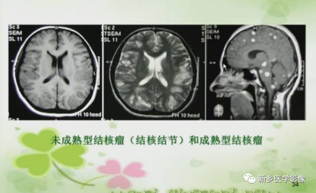 【PPT】颅内“靶征”疾病的影像诊断与鉴别