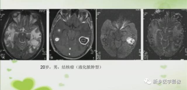 【PPT】颅内“靶征”疾病的影像诊断与鉴别