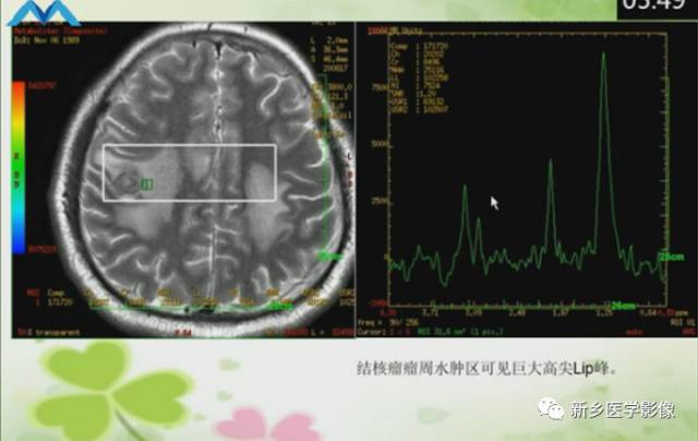 【PPT】颅内“靶征”疾病的影像诊断与鉴别
