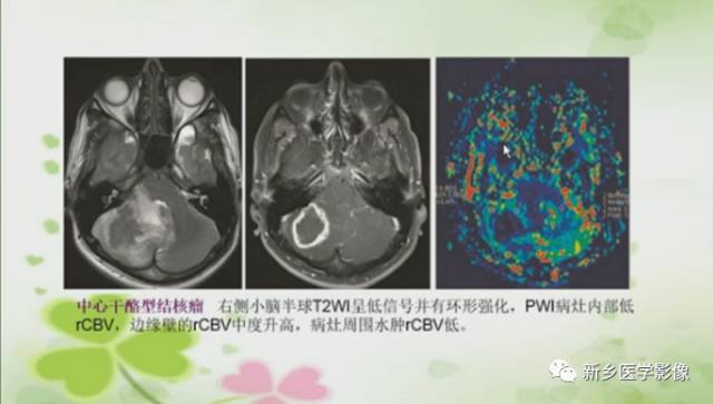 【PPT】颅内“靶征”疾病的影像诊断与鉴别