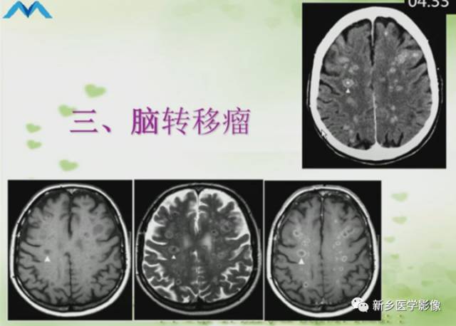 【PPT】颅内“靶征”疾病的影像诊断与鉴别