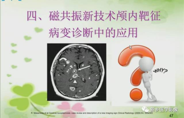 【PPT】颅内“靶征”疾病的影像诊断与鉴别