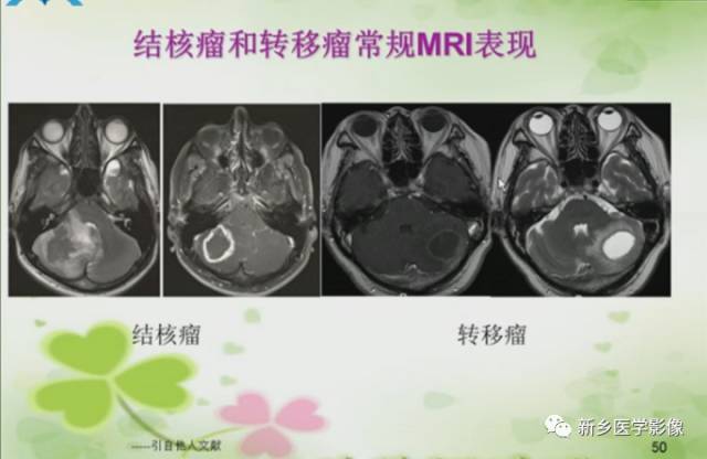 【PPT】颅内“靶征”疾病的影像诊断与鉴别