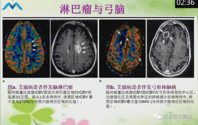 【PPT】颅内“靶征”疾病的影像诊断与鉴别