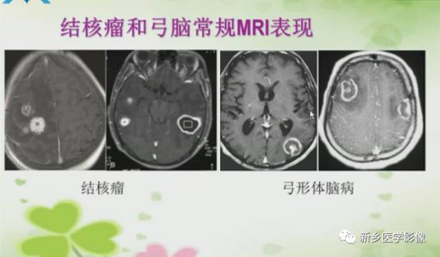 【PPT】颅内“靶征”疾病的影像诊断与鉴别