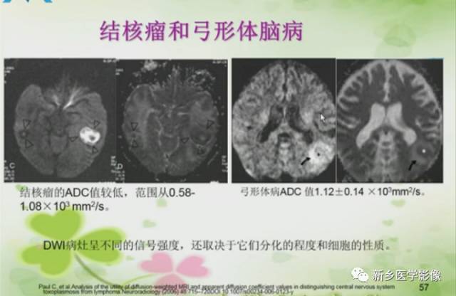 【PPT】颅内“靶征”疾病的影像诊断与鉴别