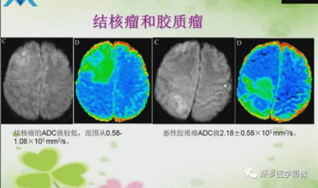 【PPT】颅内“靶征”疾病的影像诊断与鉴别