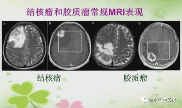 【PPT】颅内“靶征”疾病的影像诊断与鉴别