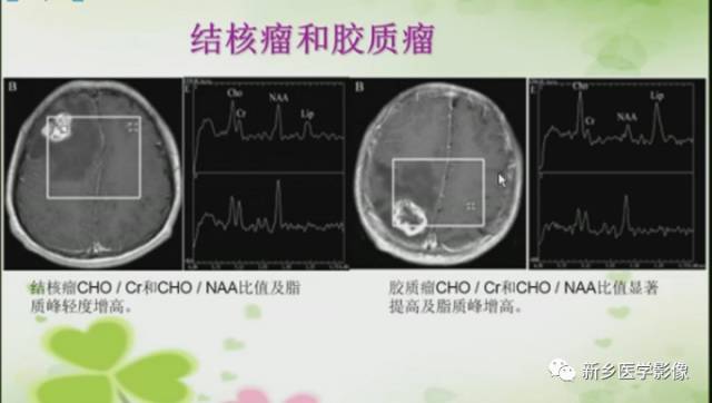 【PPT】颅内“靶征”疾病的影像诊断与鉴别