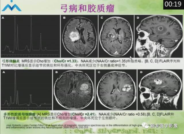 【PPT】颅内“靶征”疾病的影像诊断与鉴别