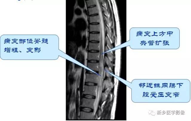 椎管内占位的影像诊断 椎管内占位的影像诊断