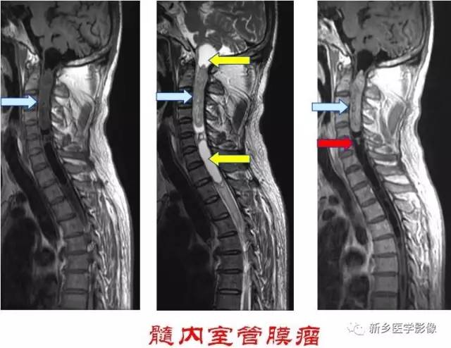 椎管内占位的影像诊断 椎管内占位的影像诊断