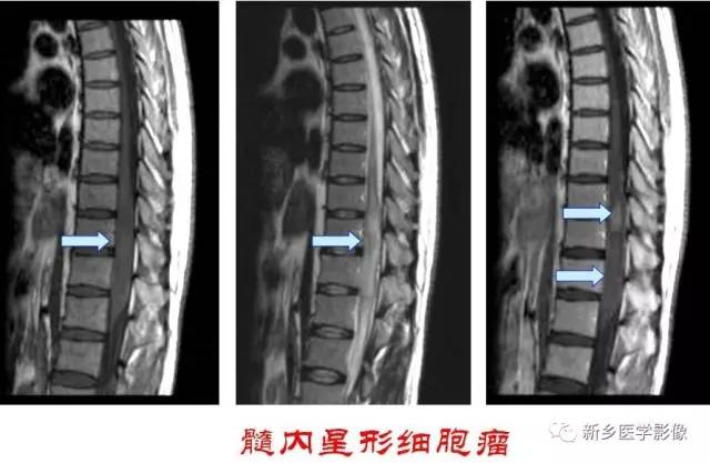 椎管内占位的影像诊断 椎管内占位的影像诊断