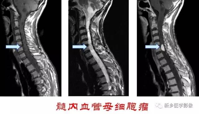 椎管内占位的影像诊断 椎管内占位的影像诊断
