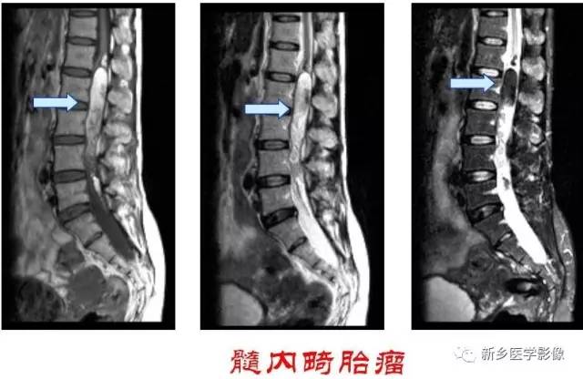 椎管内占位的影像诊断 椎管内占位的影像诊断