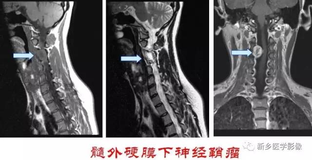 椎管内占位的影像诊断 椎管内占位的影像诊断