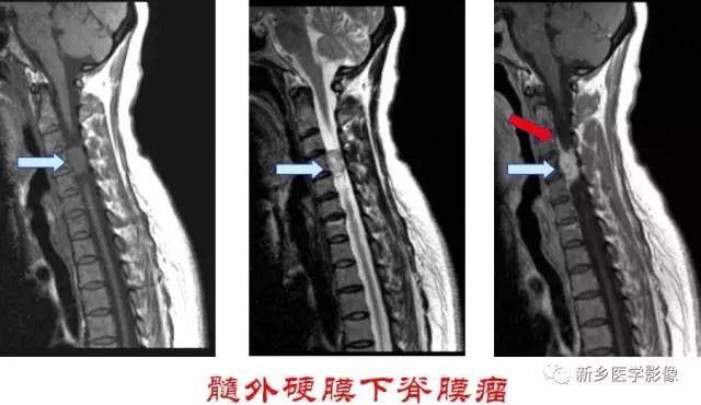 椎管内占位的影像诊断 椎管内占位的影像诊断