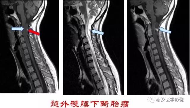 椎管内占位的影像诊断 椎管内占位的影像诊断