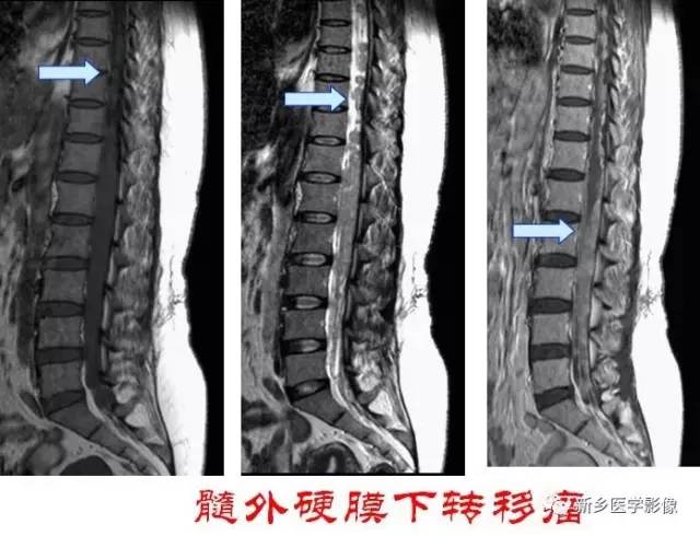 椎管内占位的影像诊断 椎管内占位的影像诊断