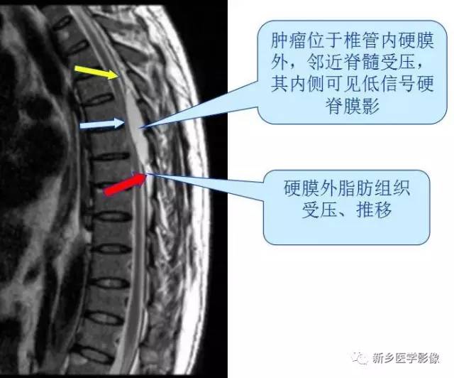 椎管内占位的影像诊断 椎管内占位的影像诊断