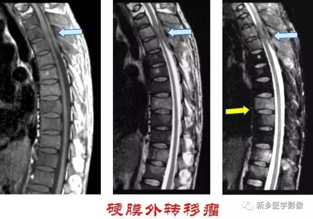 椎管内占位的影像诊断 椎管内占位的影像诊断