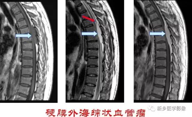 椎管内占位的影像诊断 椎管内占位的影像诊断