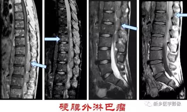 椎管内占位的影像诊断 椎管内占位的影像诊断
