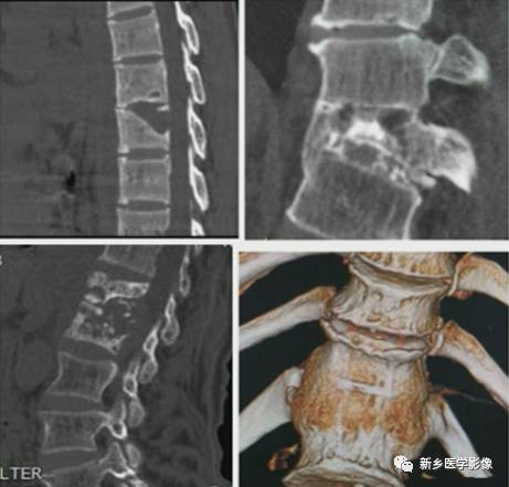 脊柱布病与结核鉴别，应想到这7个方面