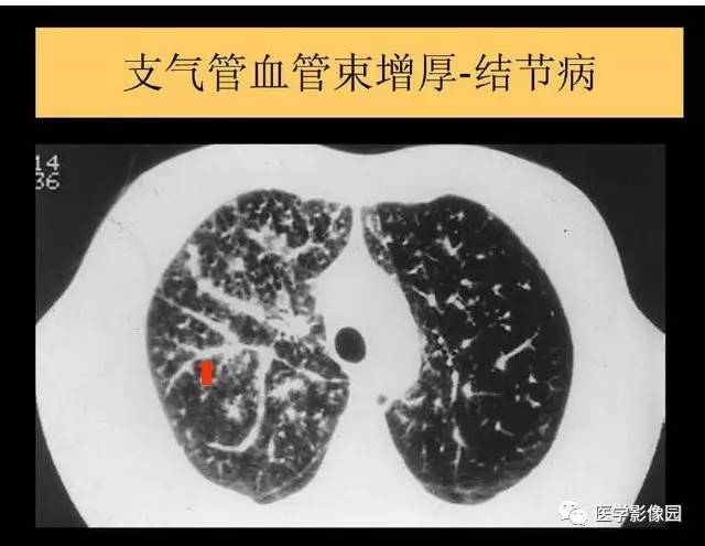 【PPT】DPLD胸部HRCT鉴别诊断