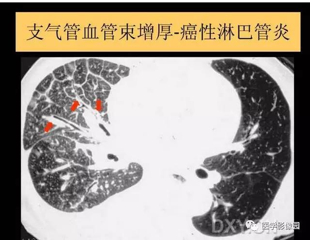 【PPT】DPLD胸部HRCT鉴别诊断