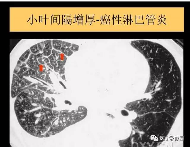 【PPT】DPLD胸部HRCT鉴别诊断