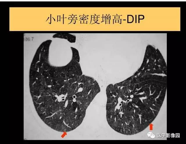 【PPT】DPLD胸部HRCT鉴别诊断