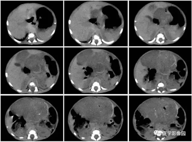【病例】腹腔黏液型炎性肌纤维母细胞瘤1例CT 【病例】腹腔黏液型炎性肌纤维母细胞瘤1例CT