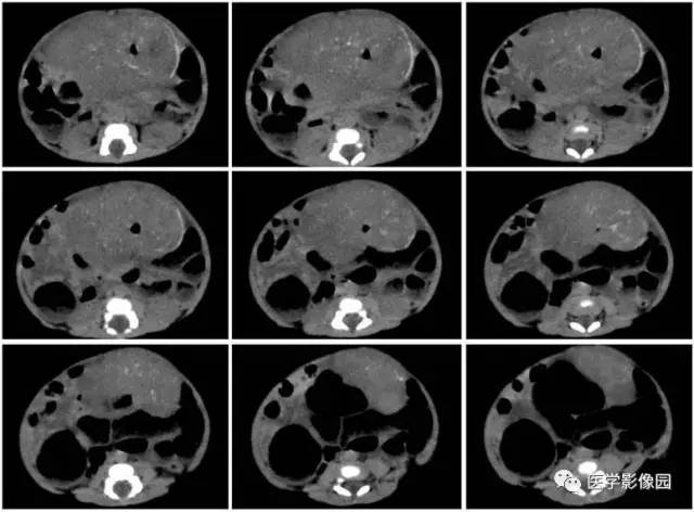 【病例】腹腔黏液型炎性肌纤维母细胞瘤1例CT