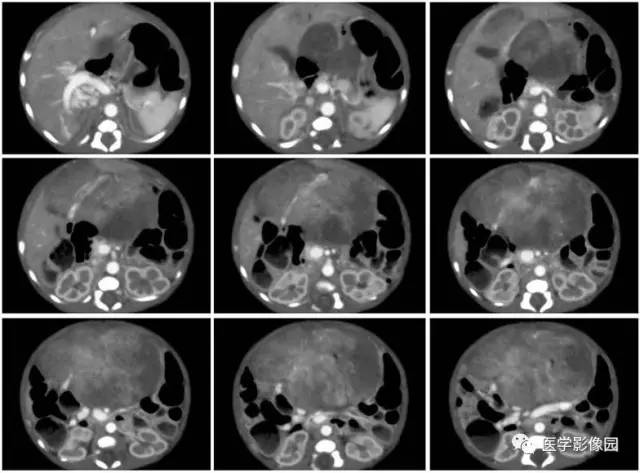 【病例】腹腔黏液型炎性肌纤维母细胞瘤1例CT 【病例】腹腔黏液型炎性肌纤维母细胞瘤1例CT