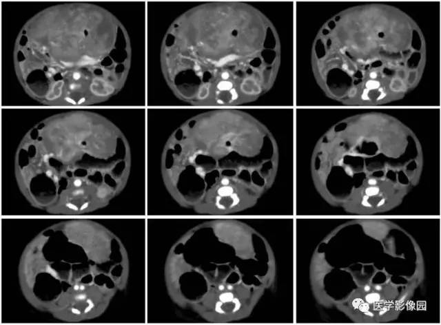 【病例】腹腔黏液型炎性肌纤维母细胞瘤1例CT 【病例】腹腔黏液型炎性肌纤维母细胞瘤1例CT