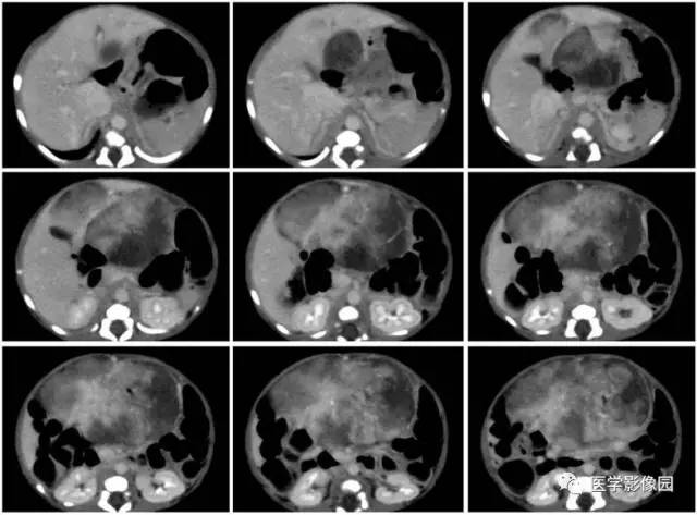 【病例】腹腔黏液型炎性肌纤维母细胞瘤1例CT 【病例】腹腔黏液型炎性肌纤维母细胞瘤1例CT