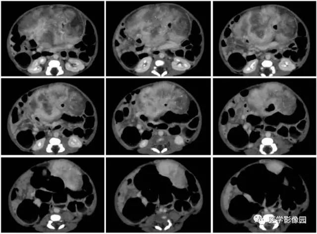 【病例】腹腔黏液型炎性肌纤维母细胞瘤1例CT 【病例】腹腔黏液型炎性肌纤维母细胞瘤1例CT