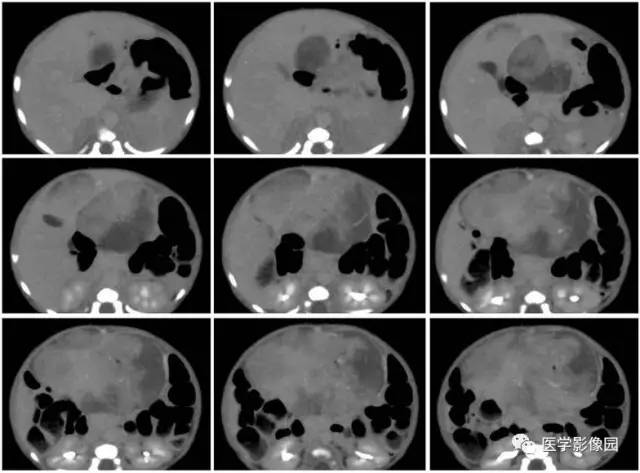 【病例】腹腔黏液型炎性肌纤维母细胞瘤1例CT 【病例】腹腔黏液型炎性肌纤维母细胞瘤1例CT