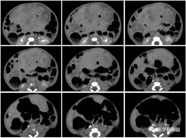 【病例】腹腔黏液型炎性肌纤维母细胞瘤1例CT 【病例】腹腔黏液型炎性肌纤维母细胞瘤1例CT