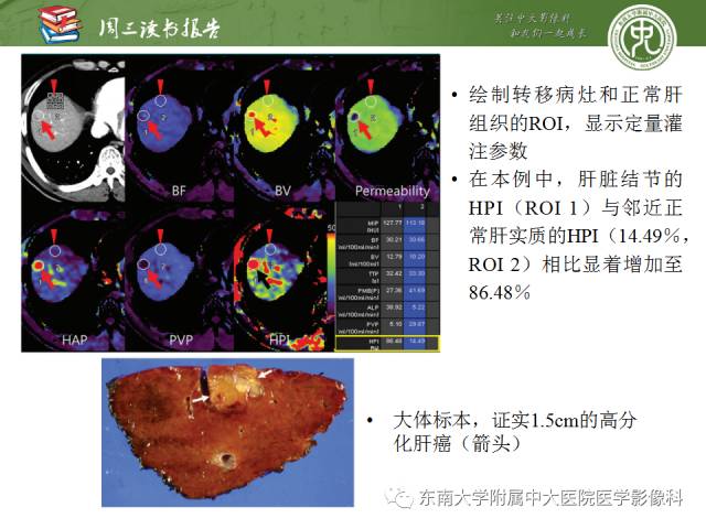 【PPT】肝脏CT灌注在肿瘤学中的原理及应用