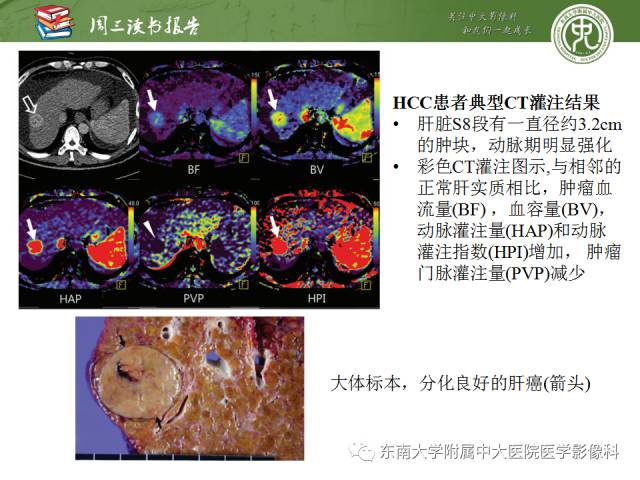 【PPT】肝脏CT灌注在肿瘤学中的原理及应用